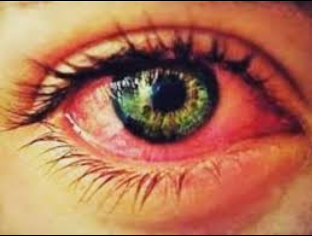 डोळे येण्याची लक्षणे आढळल्यास त्वरीत आरोग्य विभागाशी संपर्क साधा   आतापर्यंत 725 रुग्ण बरे – जिल्हा आरोग्य अधिकाऱ्यांची माहिती